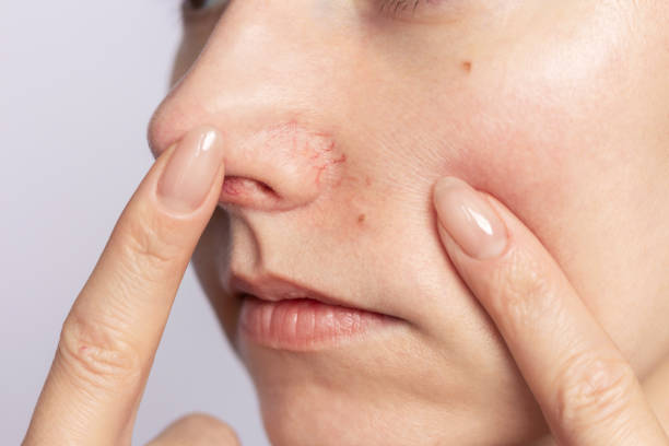 Close-up of a red nose, suggesting irritation that nasal strips might soothe.
