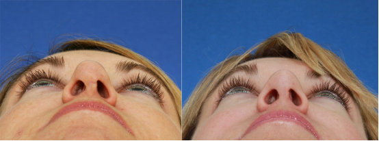 Illustration of nasal strips supporting the nasal valve during sleep.