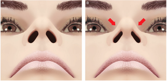 Side view of a person lying down using nasal strips at night.